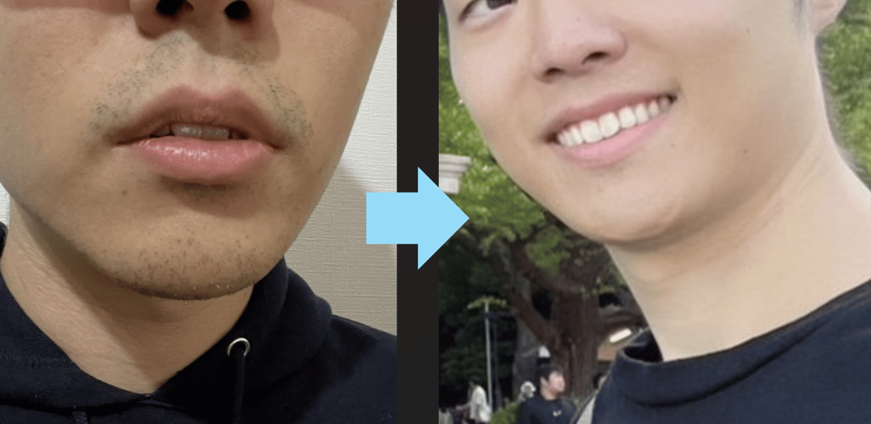 メンズ脱毛を実際に体験した症例写真